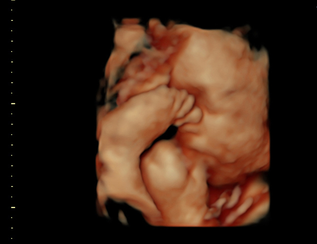 3D ultrasound image at 31 weeks